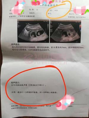 贵州49岁姐姐停经一年多+卵巢衰退，男方弱精，做三代试管婴儿一次成功怀双胞胎